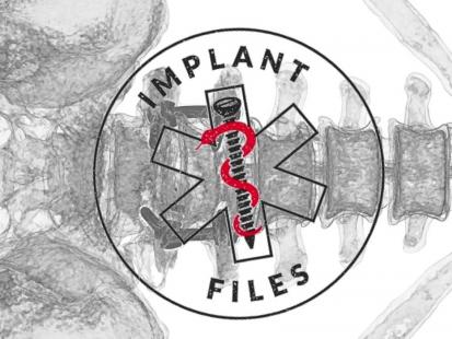 Implant files