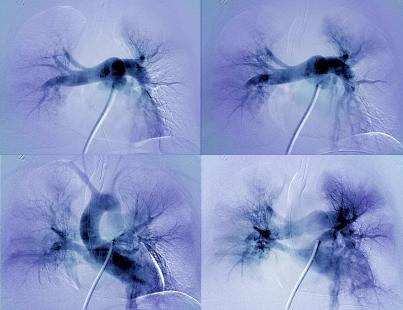 Angiographie de l’artère pulmonaire d’un patient après une crise cardiaque, montrant une embolie pulmonaire massive