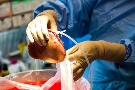 Prélèvement partiel du foie sur un donneur vivant par laparoscopie.