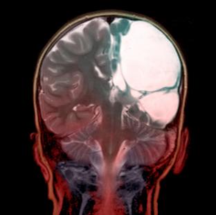 IRM d'un cerveau d'enfant atteint d'infirmité motrice cérébrale due à une encéphalomalacie (en blanc, à droite)